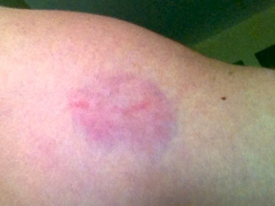 What that little nip looked like 2 days later (photo by me in an awkward pose with my iPhone)